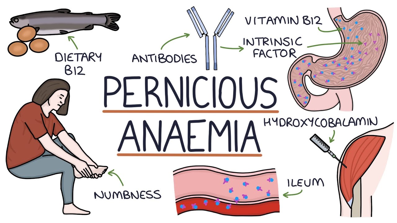 Explain Pernicious Anaemia